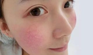 脸上红血丝明显怎么办 脸上红血丝怎么回事